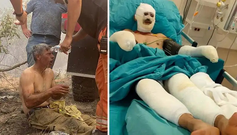 Orman İşçisinden "Yanıyorum" Feryadı: Tedavisi Devam Ediyor