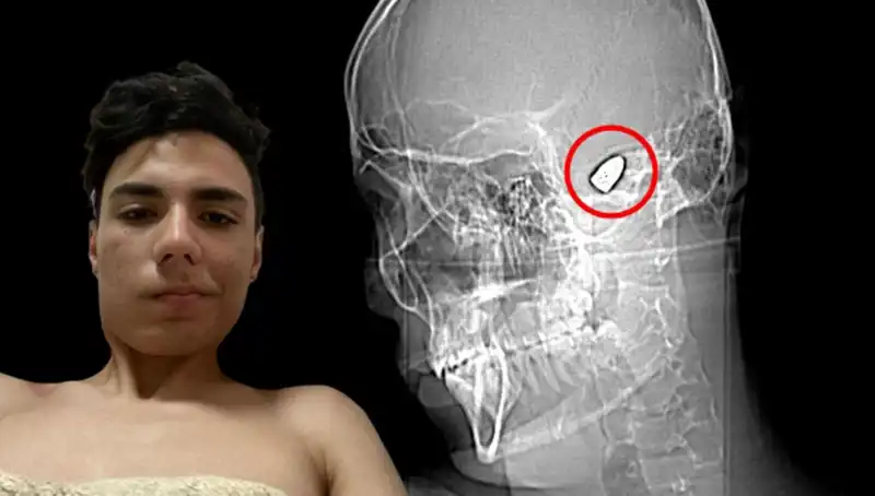 Kafasında Patlamaya Hazır Bomba Taşıyan Adamın Şok Edici Hikayesi