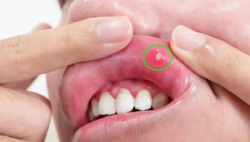 Vücudun Sizi Uyardığı 5 B Vitamini Eksikliği Belirtisi